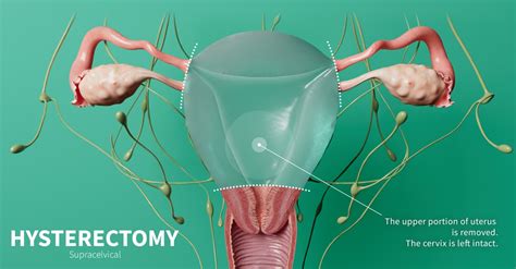 hysterectomy in normanton